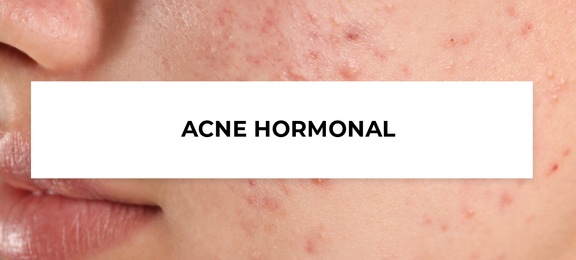 acne hormonal
