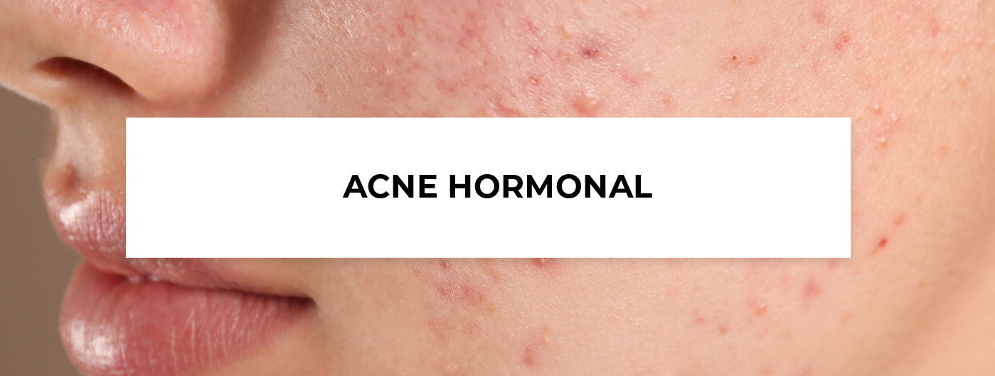 Acne hormonal, o que é e como tratar? - Blog Ada Tina