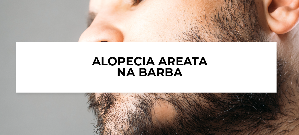 alopecia na barba